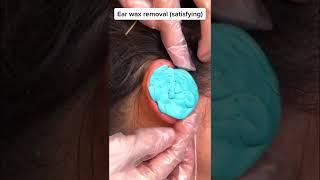 Another method of earwax removal | Very satisfying #shorts