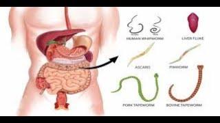 Parasite Cleanse Diet | Get Rid Of Intestinal Worms Naturally