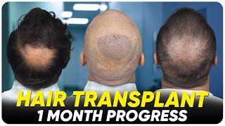 Hair Transplant in Bikaner | Best Results & Cost of Hair Transplant in Bikaner