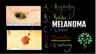 Melanoma - Symptoms, signs, diagnosis and management