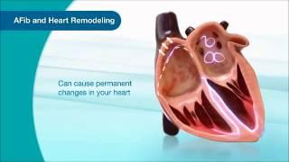 What is Atrial Fibrillation (AFib)? This Video Explains It