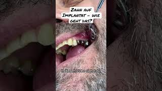 Zahn auf Implantat - Wie geht’s? #zahnimplantate #zahnkrone #schönezähne #zahnarzt #zahnersatz