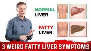 3 Weird Signs & Symptoms Of Fatty Liver – Dr.Berg