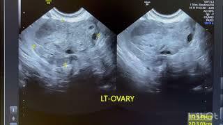 Ultrasound of PID with reporting