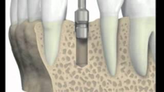 Dental Implant Placement Procedure