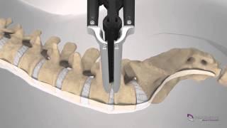 XLIF Patient Education Animation US