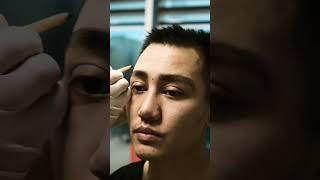 Eyebrow Transplant and Hair Transplant in One Session!