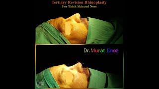 Micromotor Assisted Tertiary Revision Rhinoplasty For Thick Skinned Nose