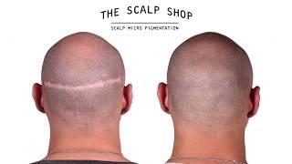 Epic Transplant Scar Camouflage With Scalp Micro Pigmentation