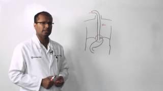 Esophageal Cancer