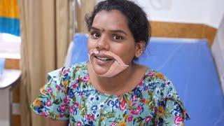 A Successful Jaw Surgery Result - Before And After | Best Jaw Surgery In Bangalore