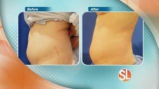 EnteBella offers non-surgical body contouring