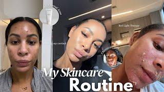 HOW I GOT RID OF MY DARK SPOTS + ACNE | skincare routine, supplements, tonics, chemical peels & MORE