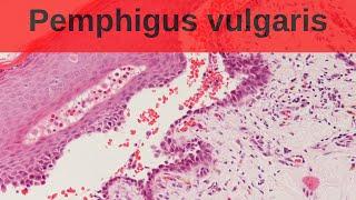 Pemphigus Vulgaris - Pathology mini tutorial