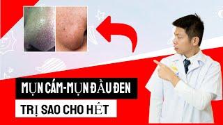 Cách trị mụn đầu đen, trị mụn cám - Dr Ngọc