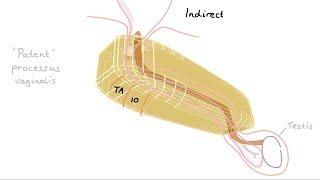 How do we get inguinal hernias?