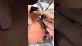 Removing tattooed eyebrows