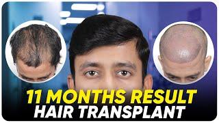 FUE Hair Transplant | Best Cost & Results of FUE Hair Transplant