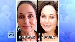 See Woman’s Incredible Before and After Facial Rejuvenation!