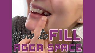 How to Fill The AGGA Space | Restorative & Orthodontic Options