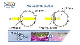 白内障ってなに？　【TV放送】目の健康情報 -あなたに代わって全て聞きます! - vol.1