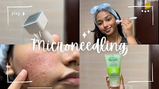 Get rid of Acne Scars || Microneedling Update