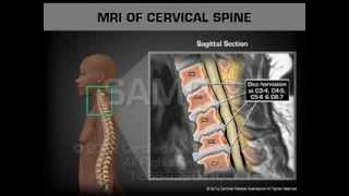 MRI of Cervical Spine