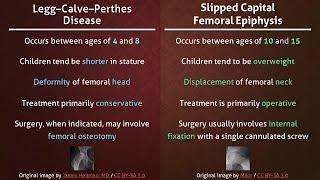 Legg–Calve–Perthes Disease vs. Slipped Capital Femoral Epiphysis