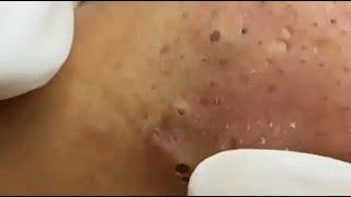 WOOW !! BLACKHEADS REMOVAL FROM THE NOSE #2 #relaxing  #blackheads