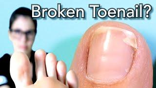 How You Fix A Broken Toenail. Watch Me Work. ENG