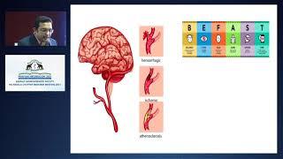 Stroke conundrums demystified - Dr Ahamed Subir