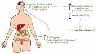 Polycystic Ovarian Syndrome (PCOS) - Pathophysiology, Symptoms, Treatment