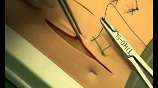 CSL: Horizontal mattress sutures