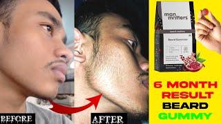 Man matters beard gummy review after 6 months | man matters beard gummy review | beard gummy |