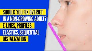 Should you Fix Class 2 Overjet in a Non-Growing Adult? E-Lines, Profiles, Sequential Distalization