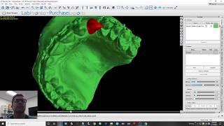 Blue Sky Bio - Single Implant Surgical Guide Design