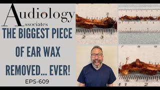 THE BIGGEST PIECE OF EAR WAX REMOVED...EVER! - EP609