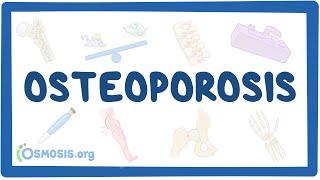 Osteoporosis - causes, symptoms, diagnosis, treatment, pathology