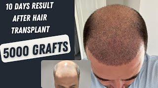 10 Days Result After Hair Transplant 5000 grafts l Hair Transplant in Turkey l Before and After