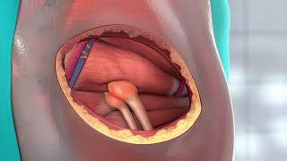 Tollestrup Piriformis Procedure