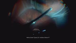 Submarine technique to separate the hyaloid from the retina in retinal detachment | Tijuana, Mexico