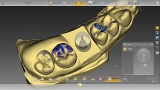 Digital Custom Abutment and Crown on Tibase, Scan Body - Inlab Dentsply Sirona