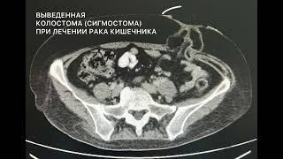 Выведенная колостома (сигмастома) кишечника при лечении рака (КТ)