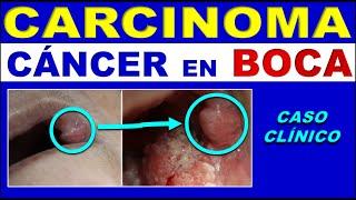 ORAL CAVITY EPIDERMOID CARCINOMA (ORAL SCAMOUS CELL CANCER)