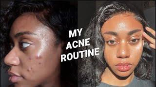 HOW I CLEARED MY ACNE using Korean Skincare Products | Medicube