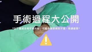 微創粉瘤全紀錄、手術過程大公開-極緻美型·文心極緻美型皮膚科診所整形手術-林子鈞醫師：台中粉瘤_粉瘤手術_微創粉瘤_粉瘤健保