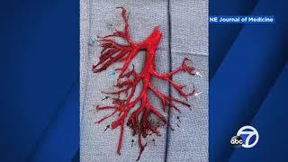 Man coughs up blood clot in perfect shape of bronchial tree