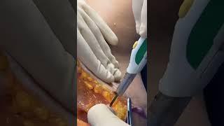 TRANSUMBILICAL SILICONE BOOB JOB & ABDOMINOPLASTY BY DR GABRIEL PATINO 12 23 2024.(510)525-7999