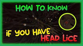 How to know if you have Head Lice #shorts #naturalhair #haircaretips #headlice #haircare