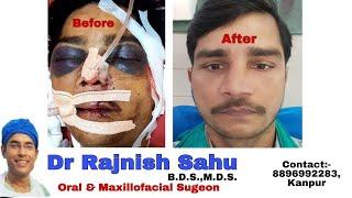 Plastic Surgery Face Before - After|| Face Surgery || Face Reconstruction || @rajnishsahu82